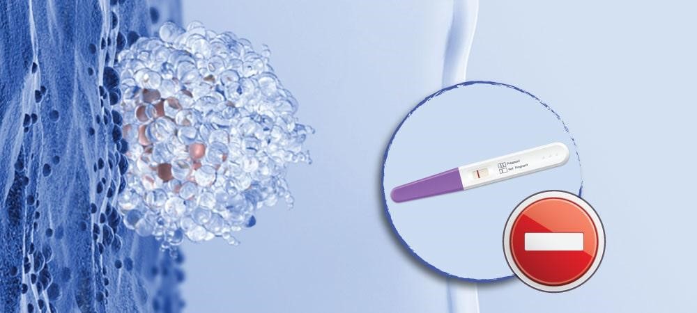 Chuyển phôi thất bại: Nguyên nhân, dấu hiệu và cách cải thiện