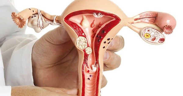 POLYP TỬ CUNG CÓ GÂY VÔ SINH?