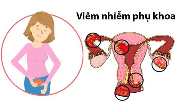 Phòng ngừa và điều trị viêm phụ khoa