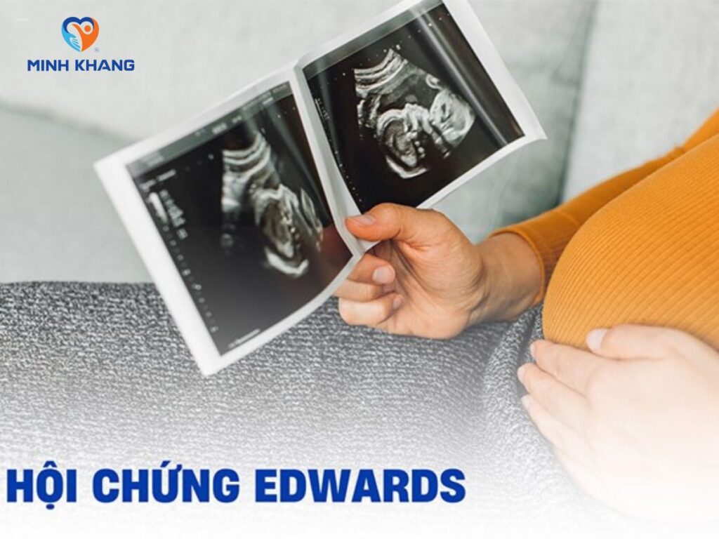 Hội chứng Edwards: Nguyên nhân, triệu chứng, phòng ngừa