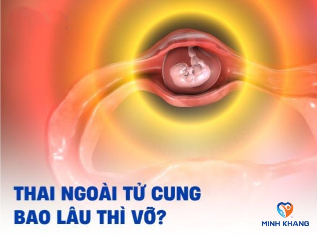 Thai ngoài tử cung bao lâu thì vỡ? Các triệu chứng nhận biết