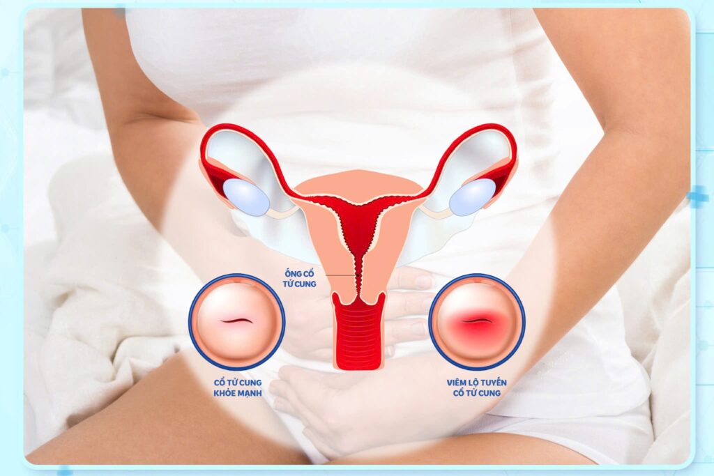 Bệnh viêm lộ tuyến cổ tử cung có nguy hiểm không?