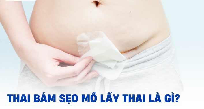 Thai trên vết mổ cũ – Biến chứng hiếm nhưng nguy hiểm mẹ cần biết